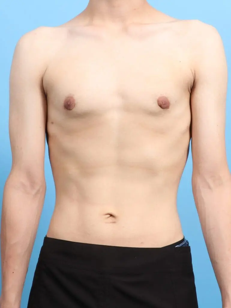 Gynecomastia - Case 24494 - After