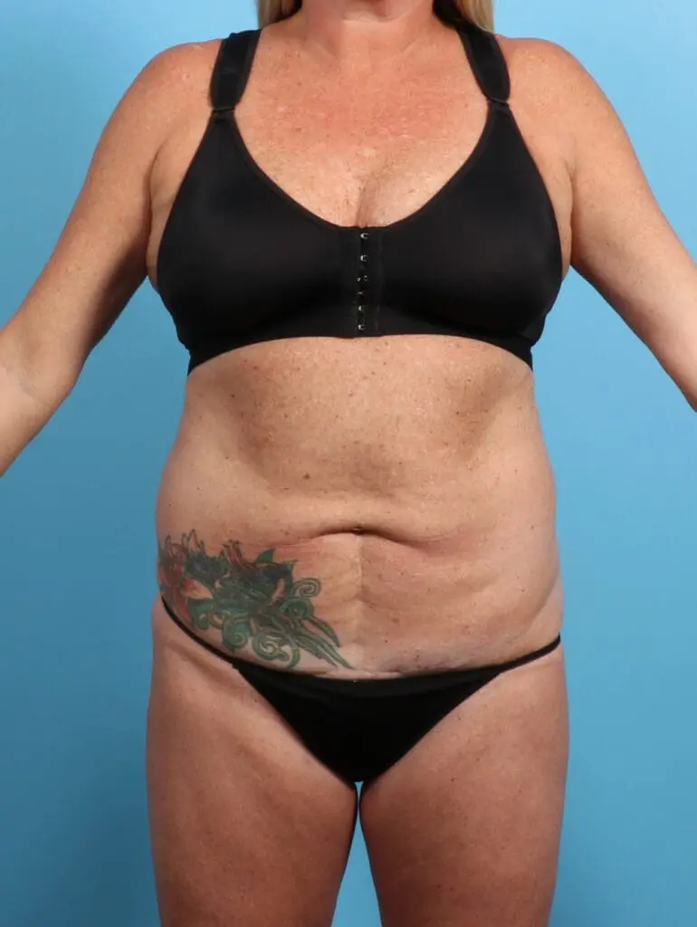 Tummy Tuck - Case 24502 - Before