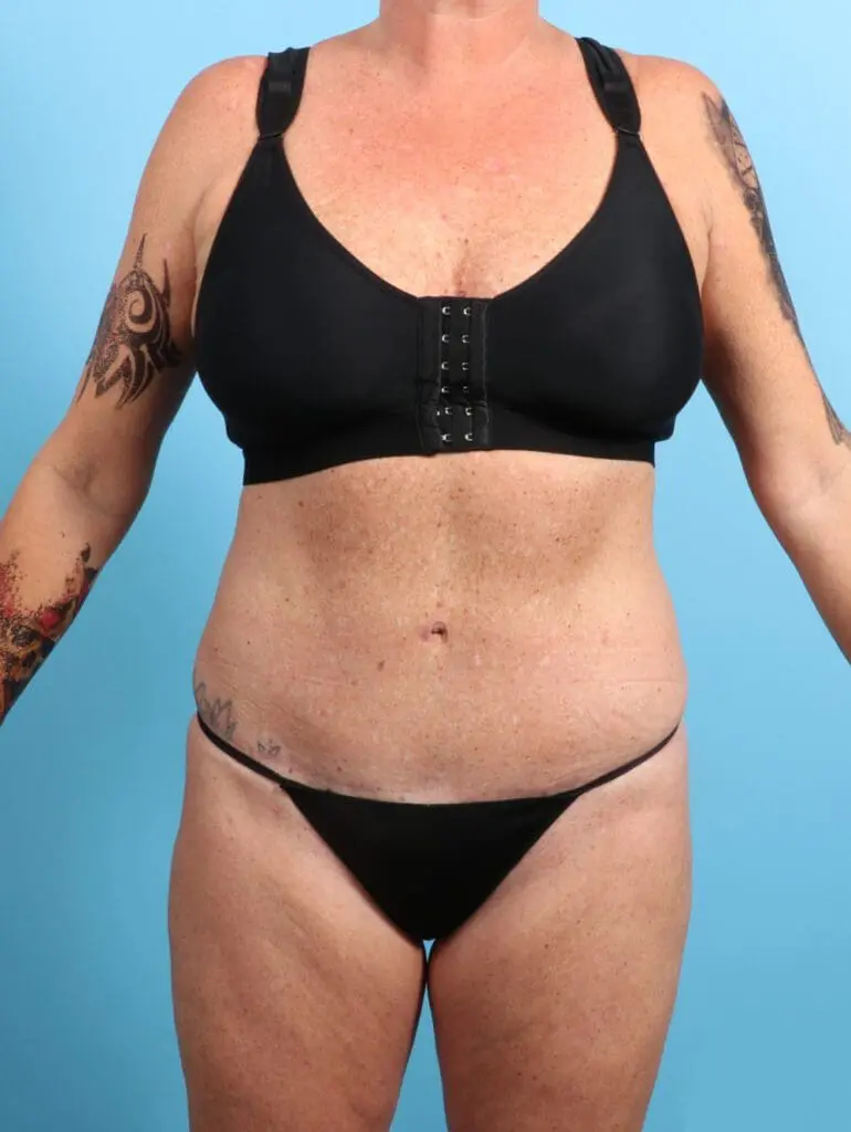 Tummy Tuck - Case 24502 - After