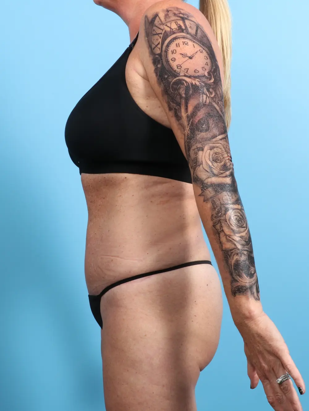 Tummy Tuck Patient Photo - Case 24502 - after view-2