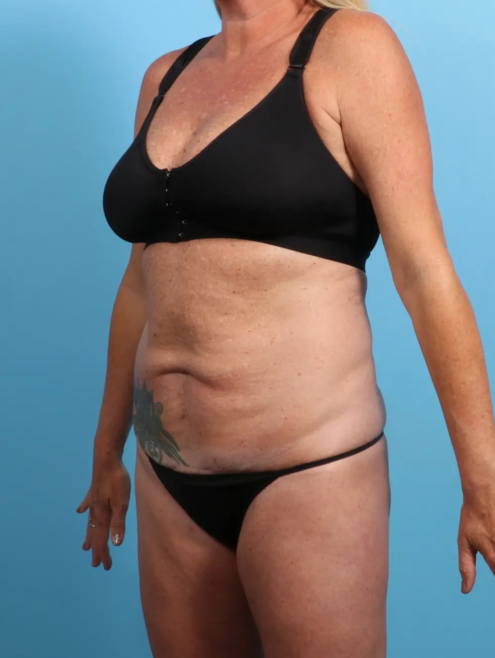 Tummy Tuck Patient Photo - Case 24502 - before view-1