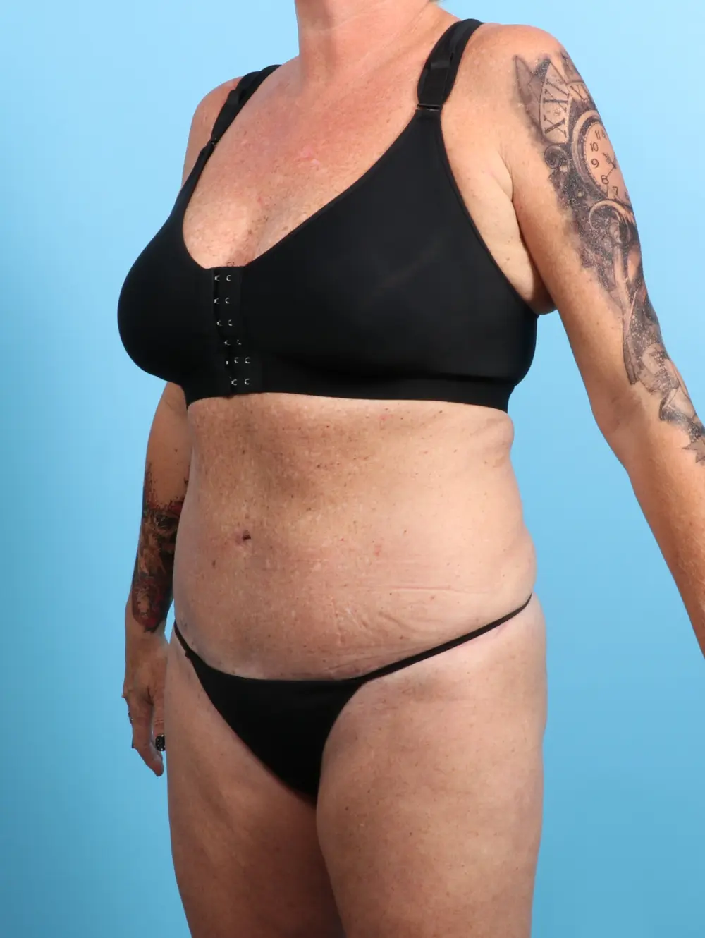 Tummy Tuck Patient Photo - Case 24502 - after view-1