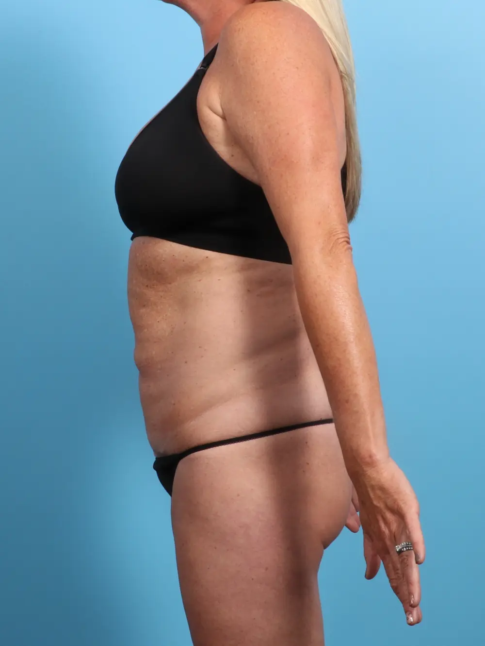 Tummy Tuck Patient Photo - Case 24502 - before view-2
