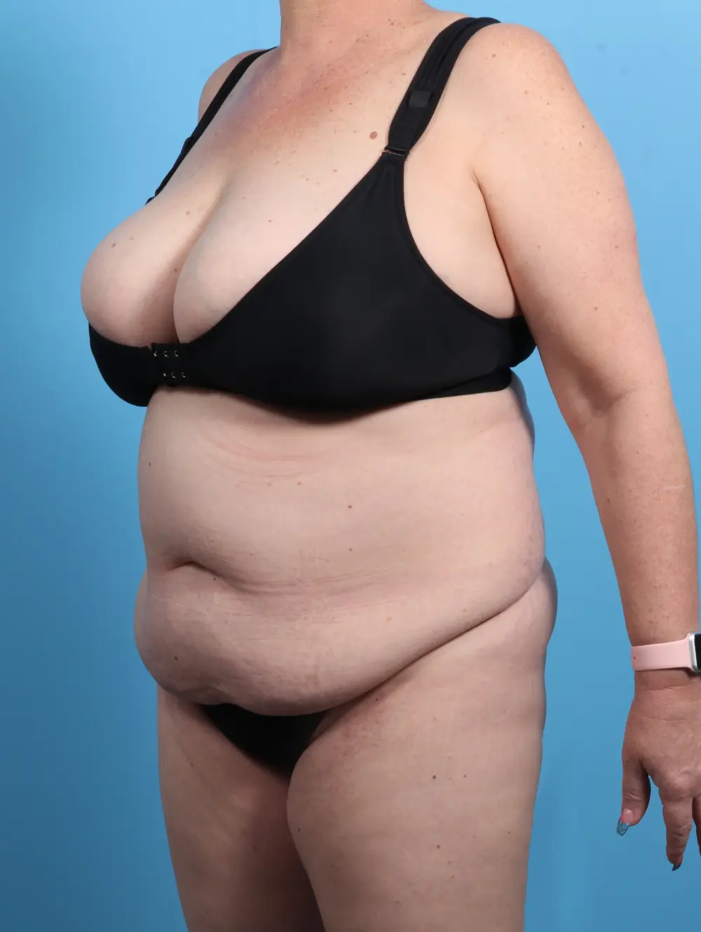 Tummy Tuck Patient Photo - Case 24524 - before view-1