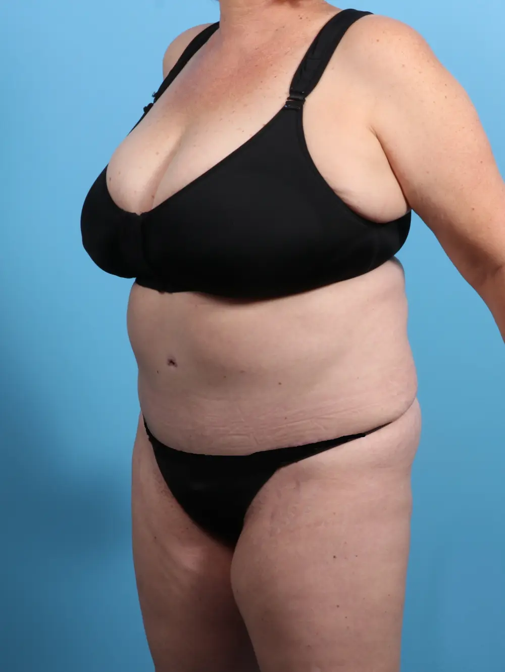 Tummy Tuck Patient Photo - Case 24524 - after view-1