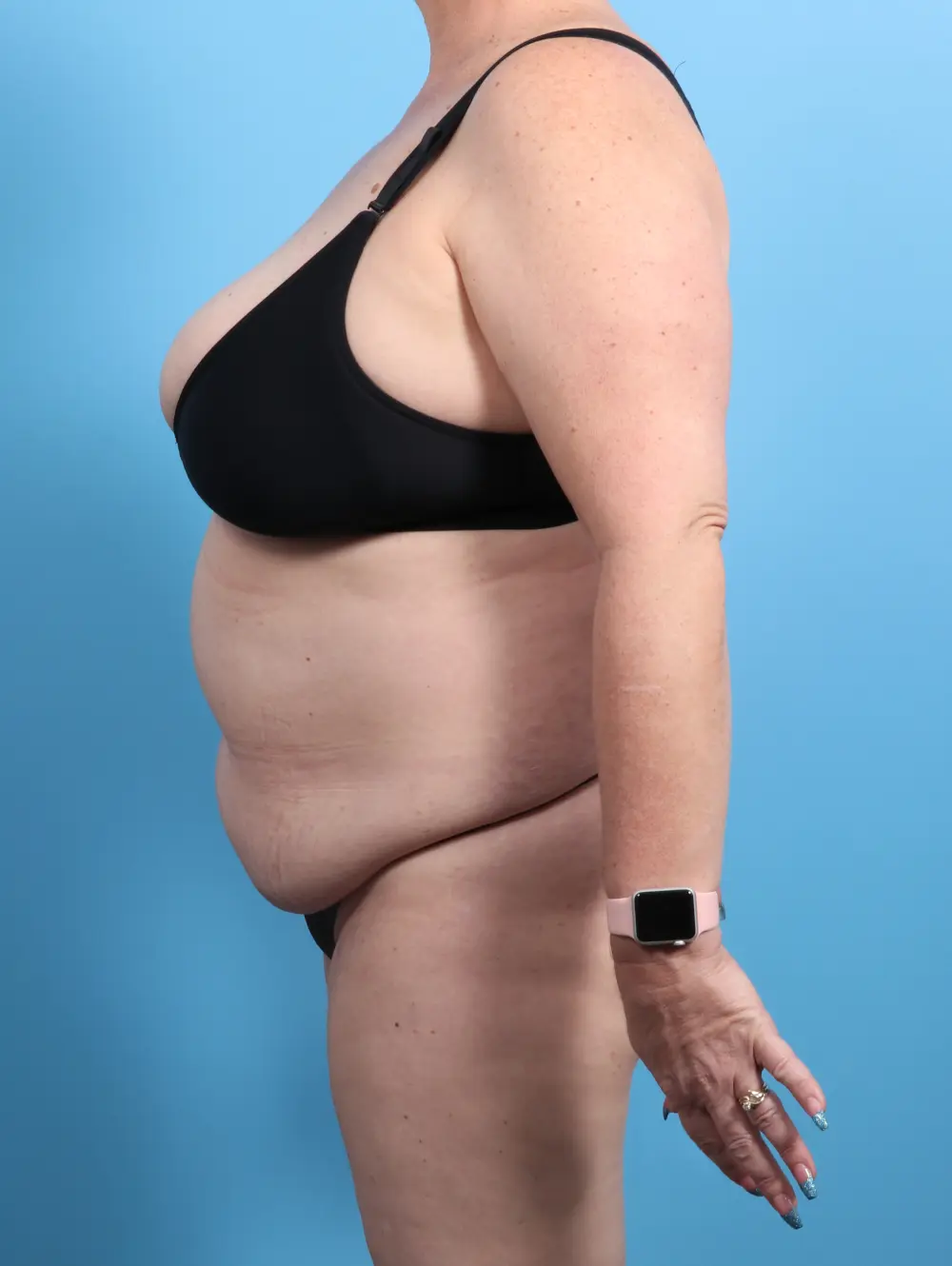 Tummy Tuck Patient Photo - Case 24524 - before view-2