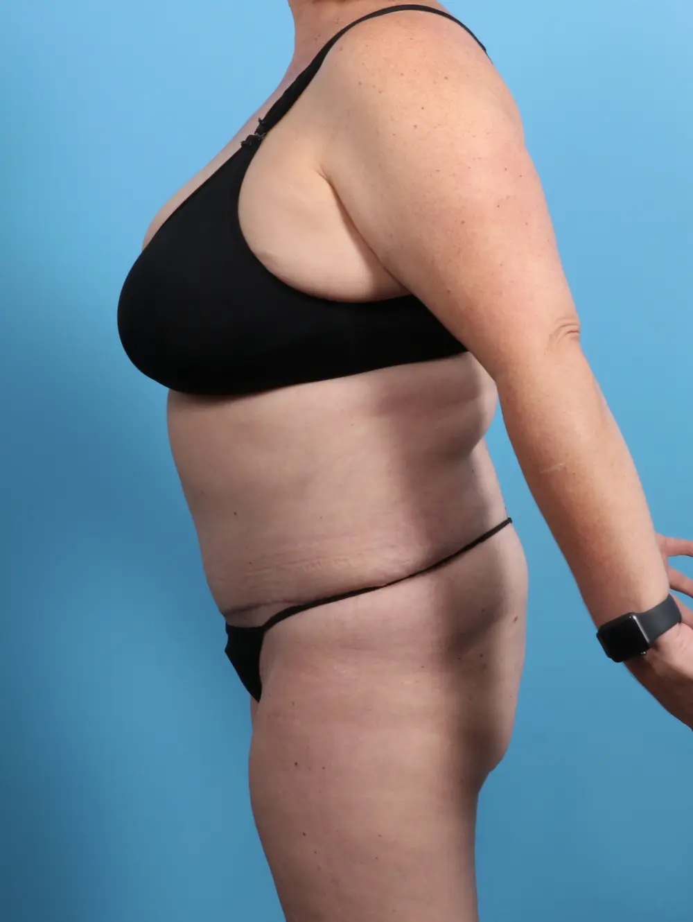 Tummy Tuck Patient Photo - Case 24524 - after view-2