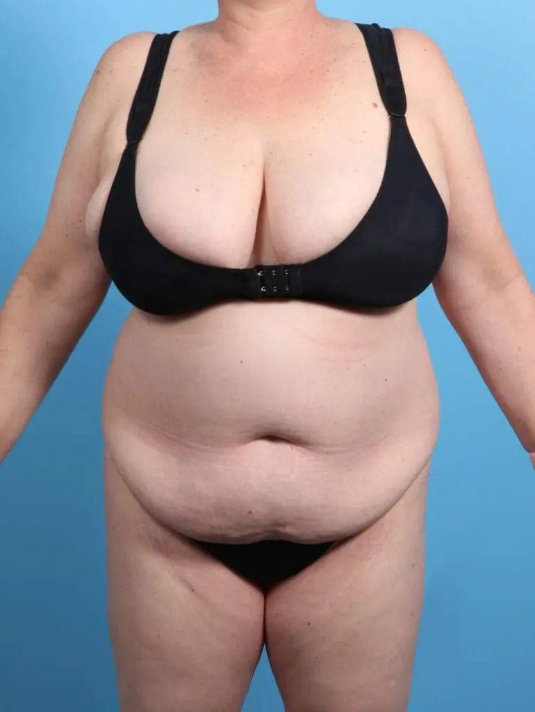 Tummy Tuck - Case 24524 - Before