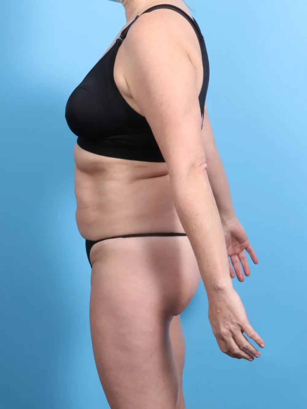 Tummy Tuck Patient Photo - Case 24564 - before view-2