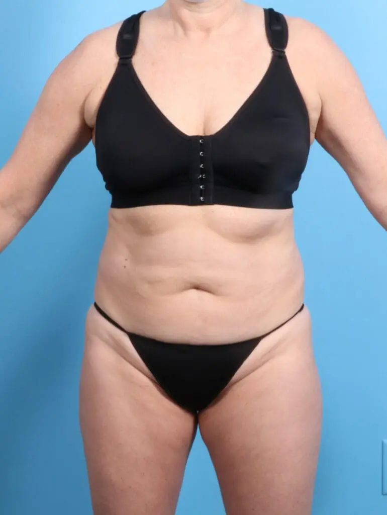 Tummy Tuck - Case 24564 - Before