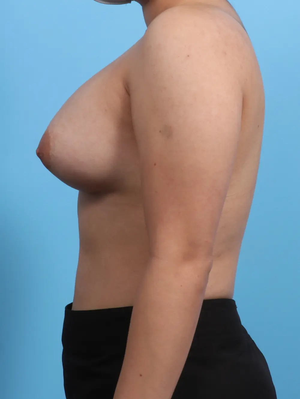 Breast Augmentation Patient Photo - Case 24624 - after view-2
