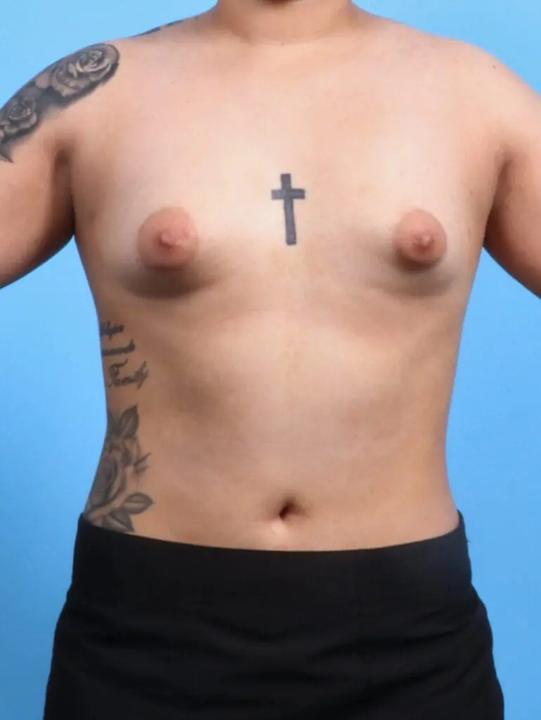 Breast Augmentation - Case 24624 - Before