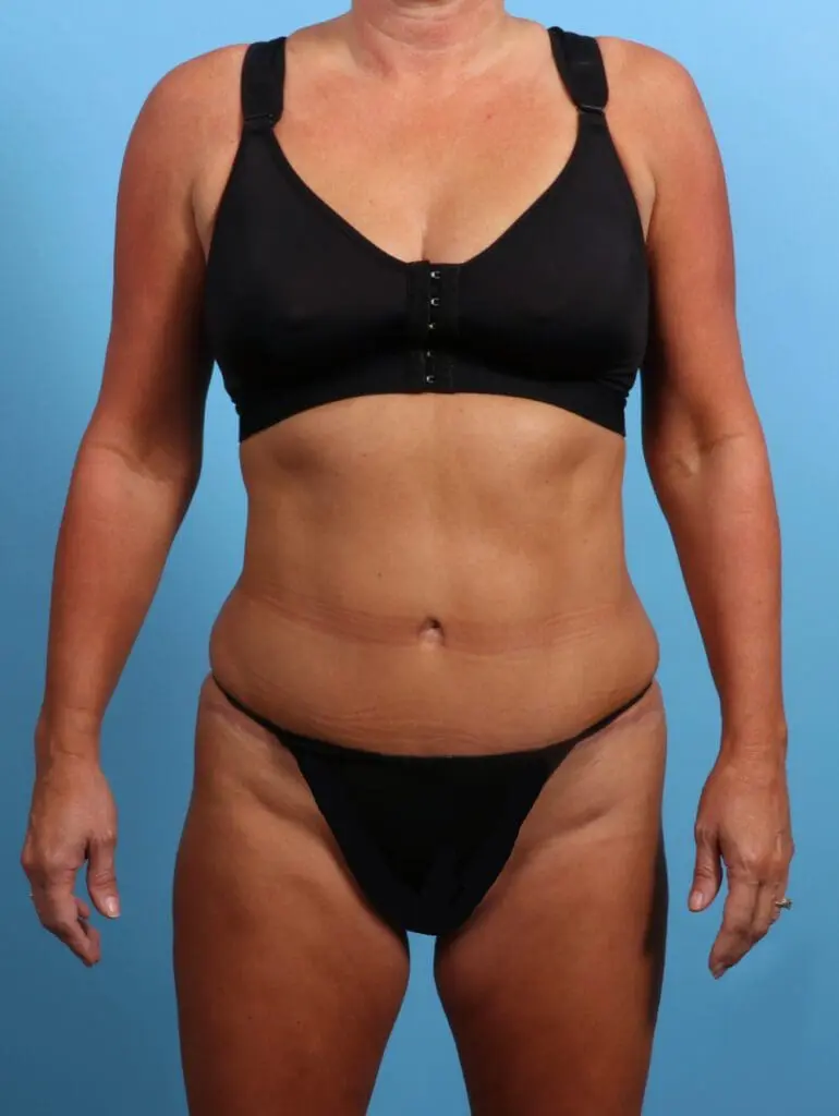 Tummy Tuck - Case 24640 - After