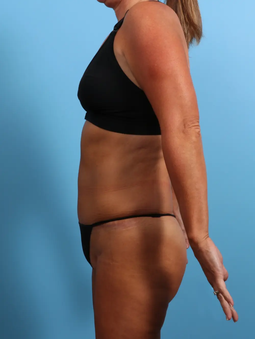 Tummy Tuck Patient Photo - Case 24640 - after view-2