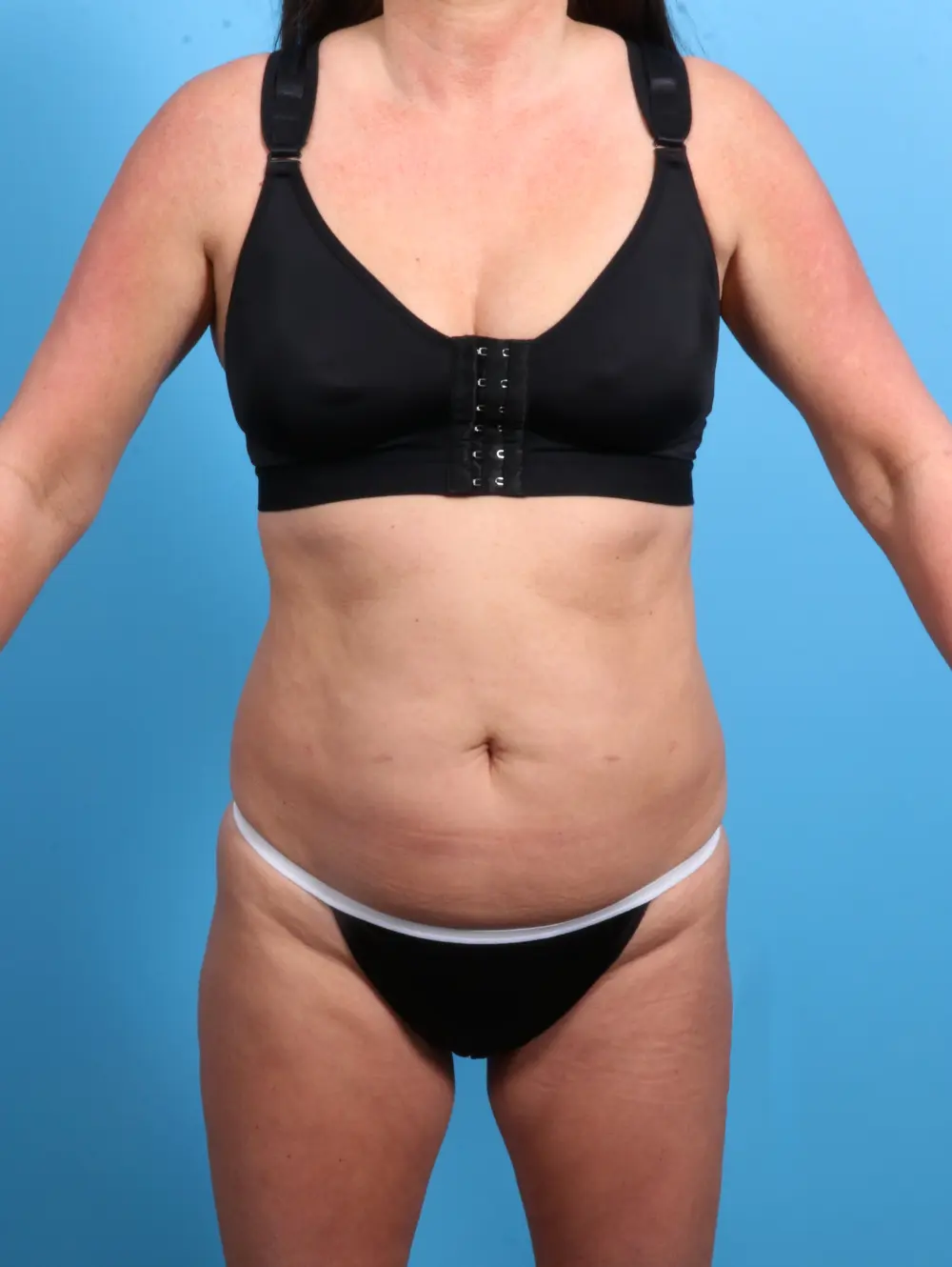 Tummy Tuck Patient Photo - Case 24640 - before view-