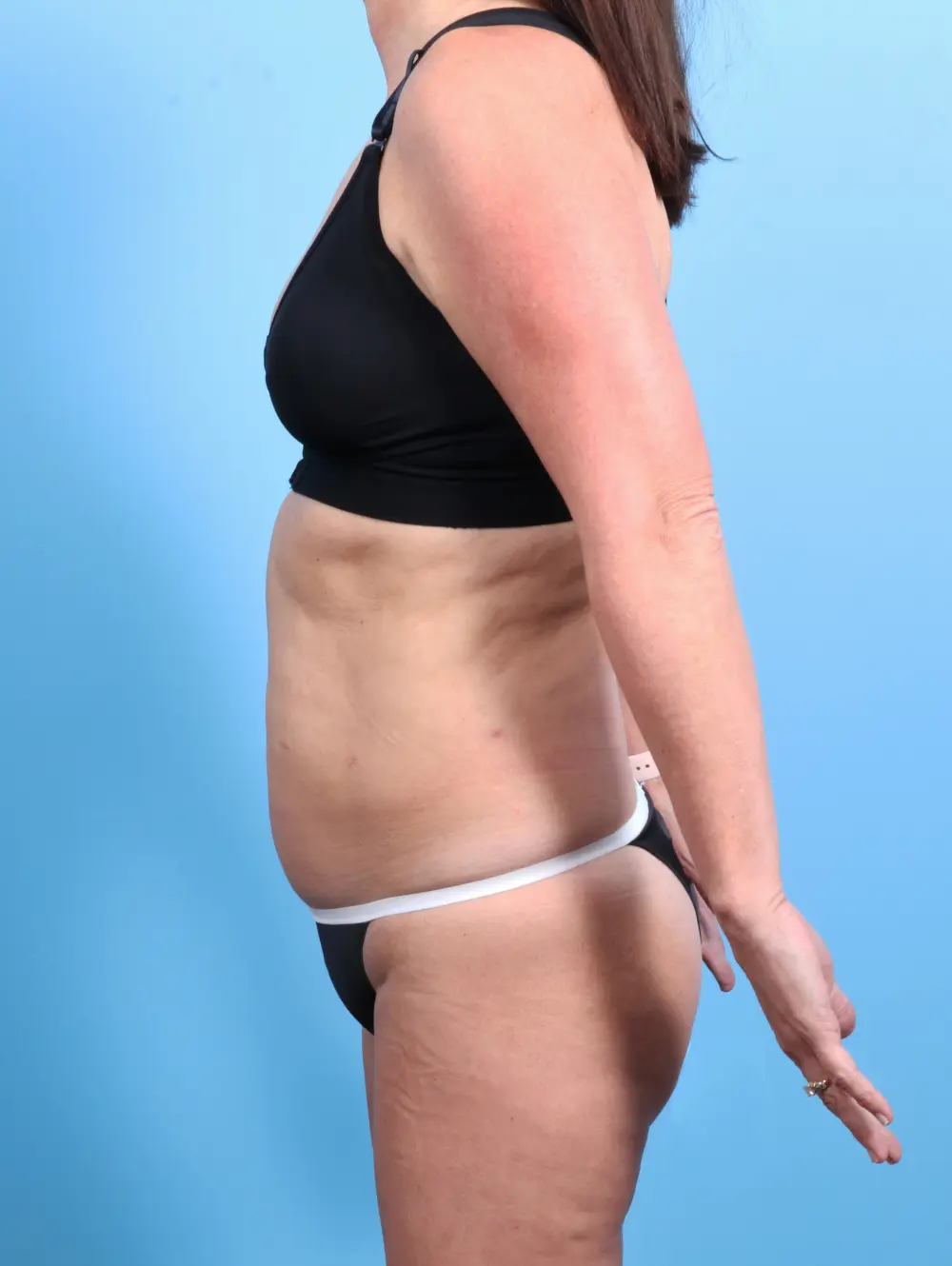 Tummy Tuck Patient Photo - Case 24640 - before view-2