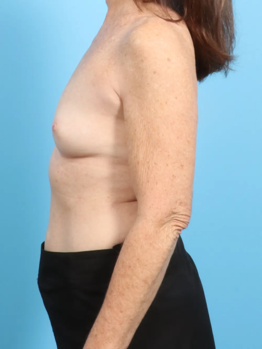 Breast Augmentation Patient Photo - Case 24648 - before view-2