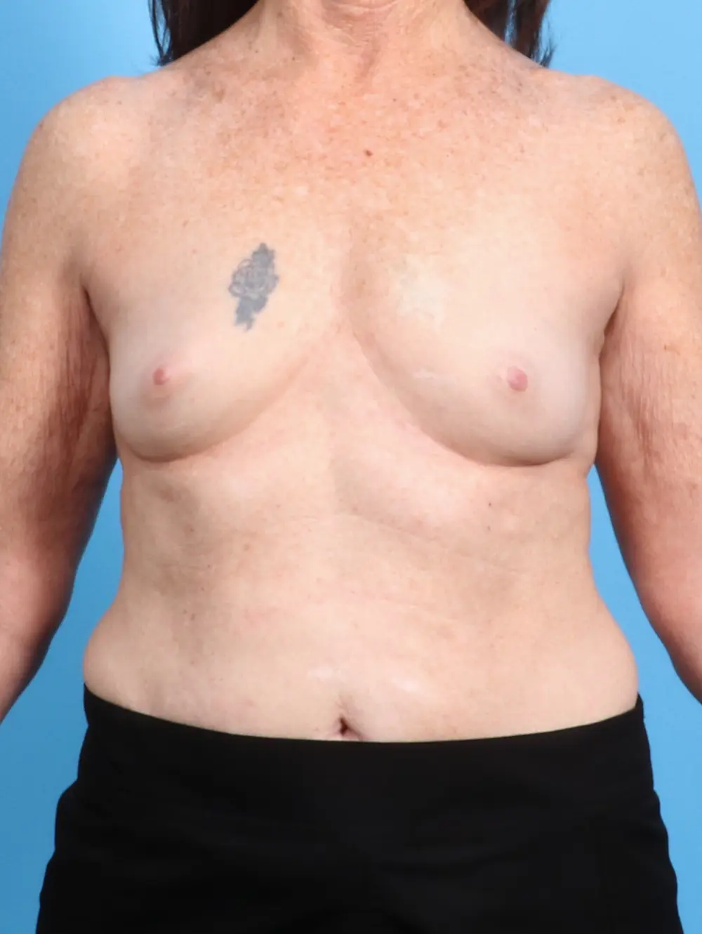 Breast Augmentation Patient Photo - Case 24648 - before view-
