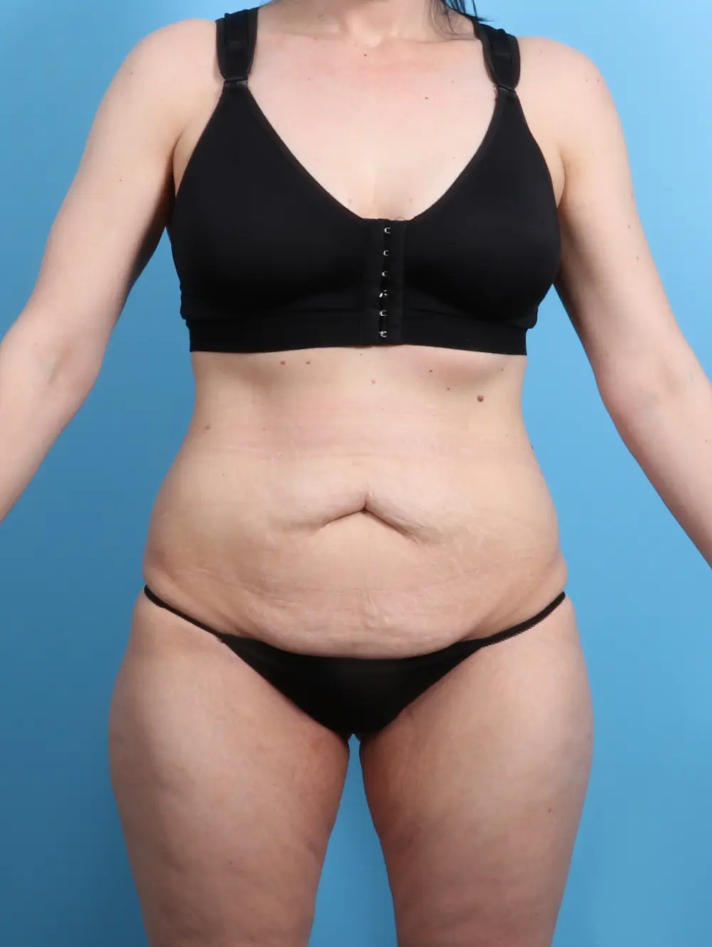 Before Lower Body Lift