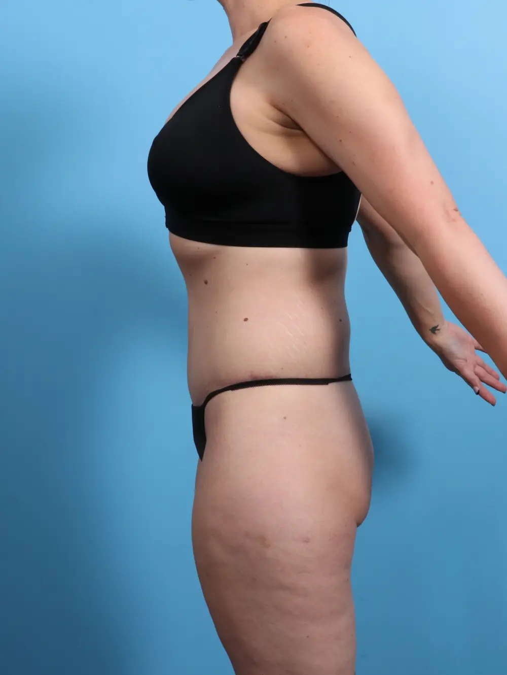 Body Lift Patient Photo - Case 24657 - after view-2