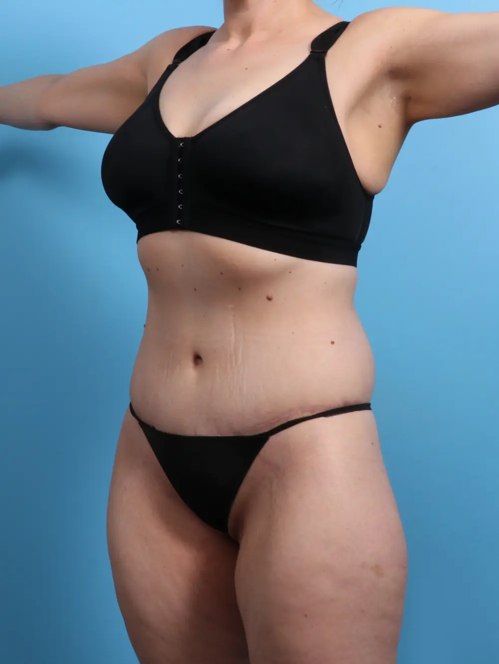 Body Lift Patient Photo - Case 24657 - after view-1