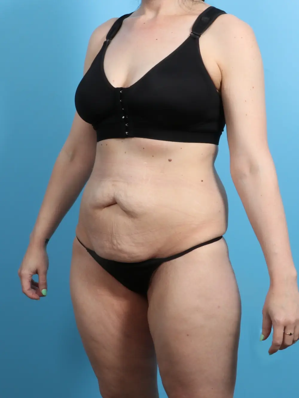 Body Lift Patient Photo - Case 24657 - before view-1