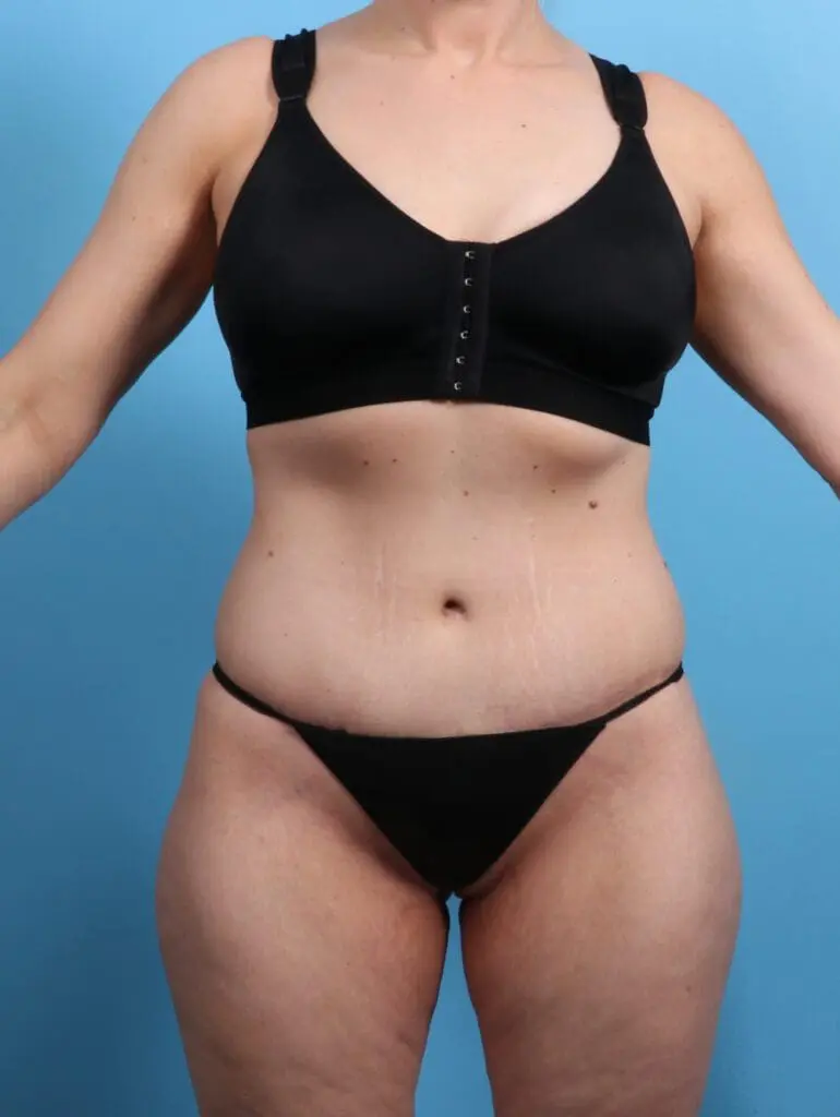 Body Lift - Case 24657 - After