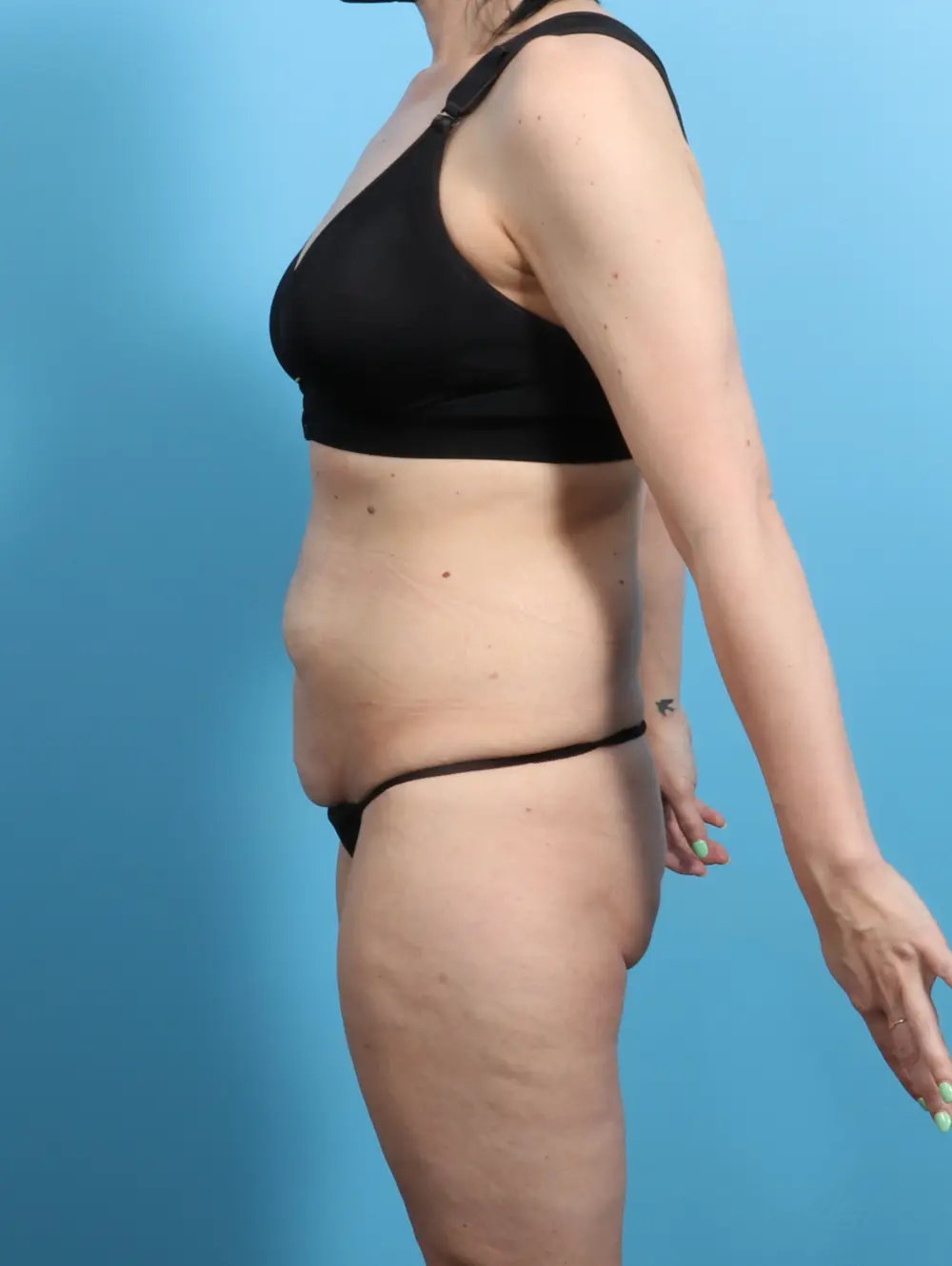 Body Lift Patient Photo - Case 24657 - before view-2