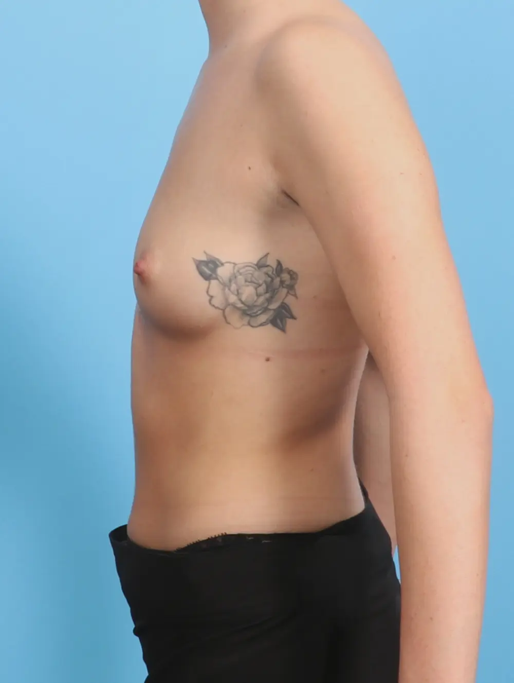 Breast Augmentation Patient Photo - Case 24683 - before view-2