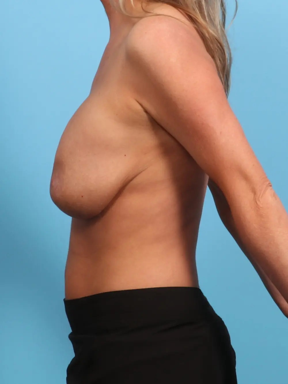 Breast Implant Revision Patient Photo - Case 24721 - before view-2