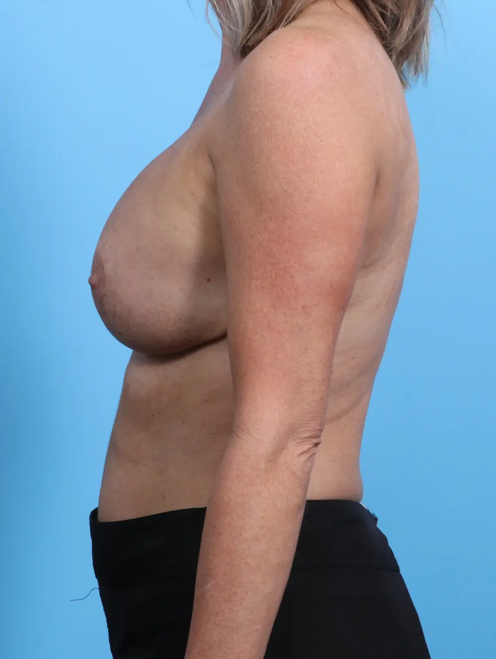 Breast Implant Revision Patient Photo - Case 24721 - after view-2