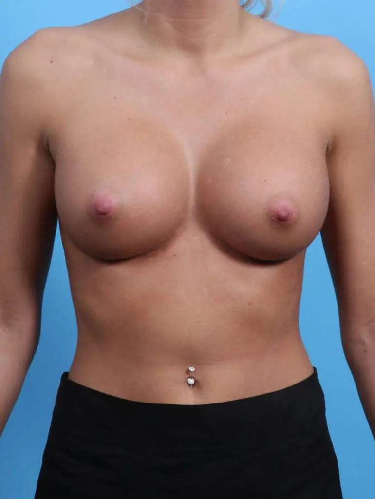 Breast Augmentation - Case 24782 - After