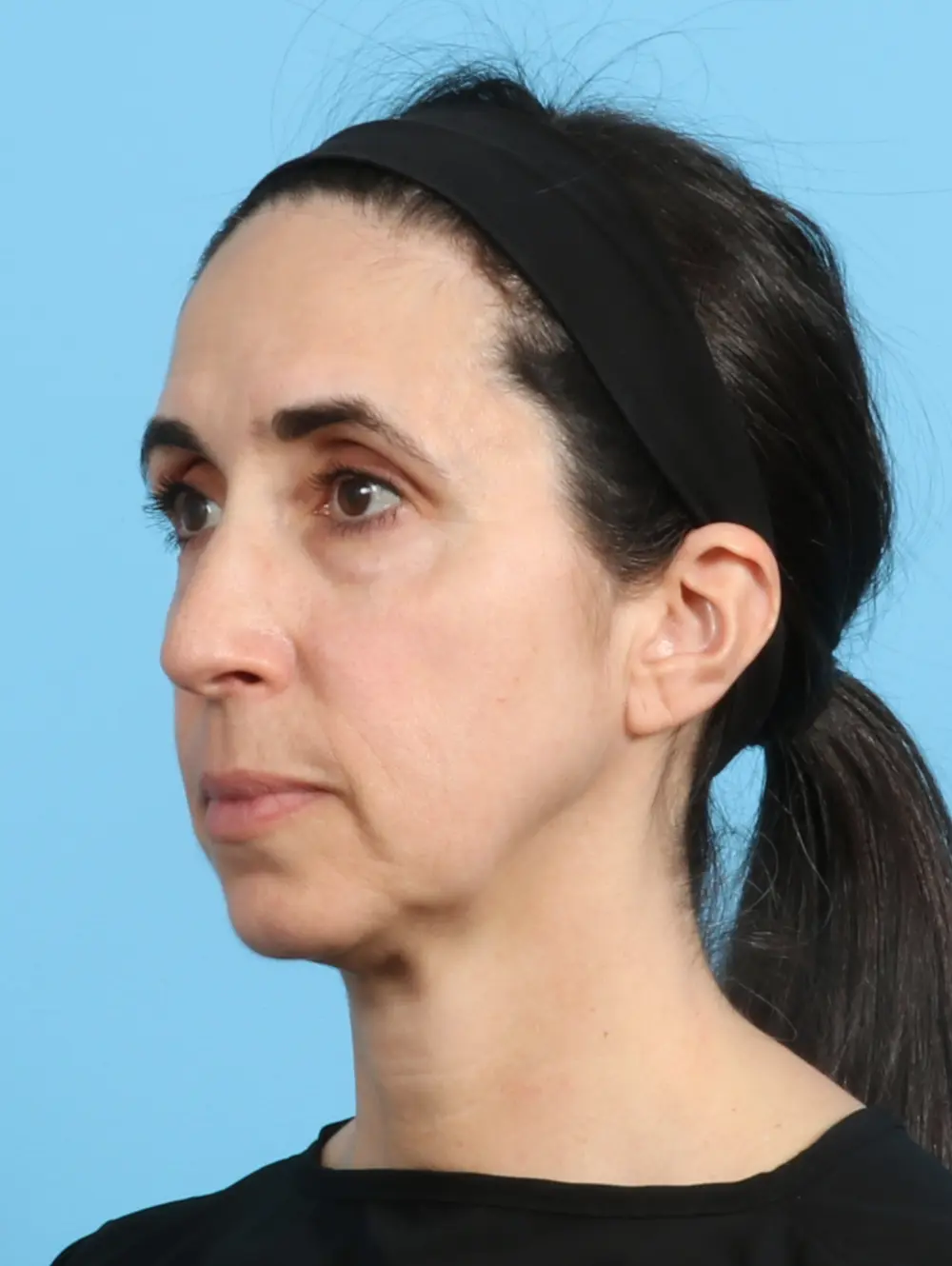 Eyelid Surgery Patient Photo - Case 24791 - before view-1