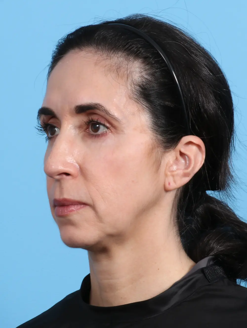 Eyelid Surgery Patient Photo - Case 24791 - after view-1