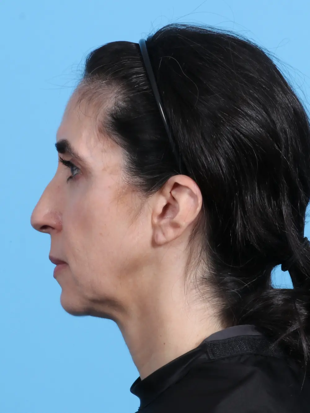 Eyelid Surgery Patient Photo - Case 24791 - after view-2