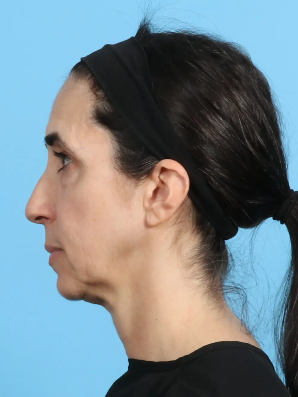 Eyelid Surgery Patient Photo - Case 24791 - before view-2