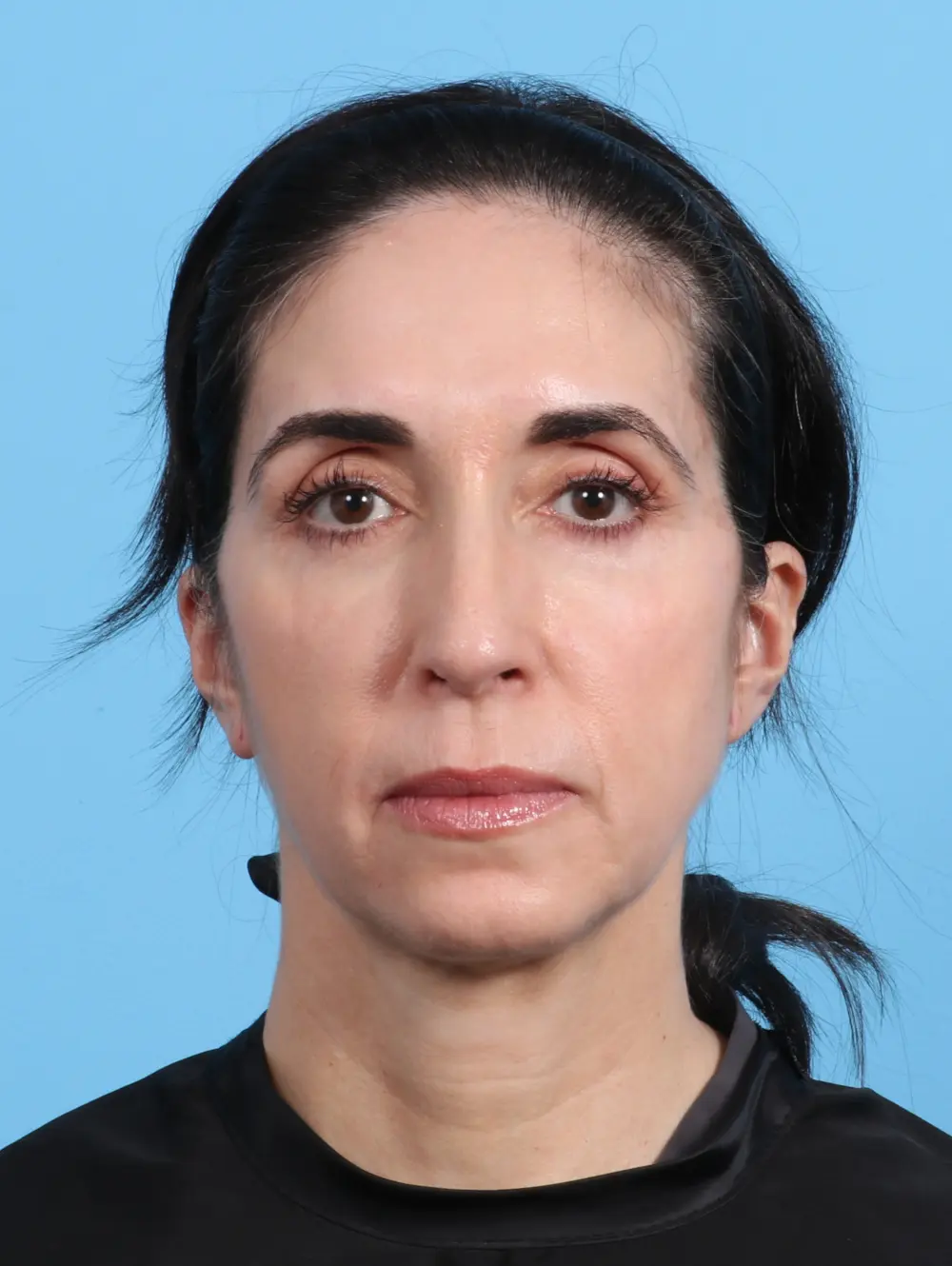 After Eyelid Surgery