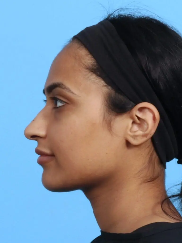 Rhinoplasty - Case 24815 - Before