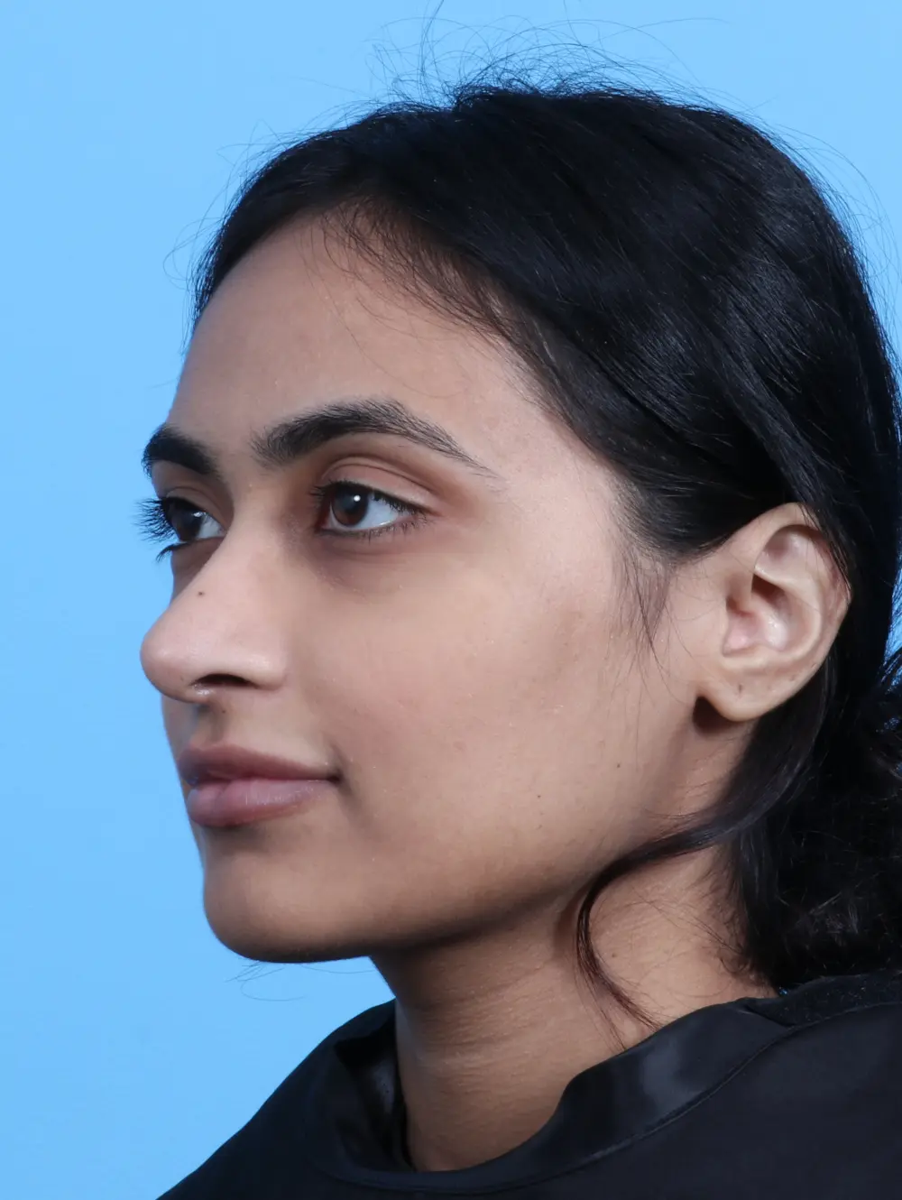 Rhinoplasty Patient Photo - Case 24815 - after view-1