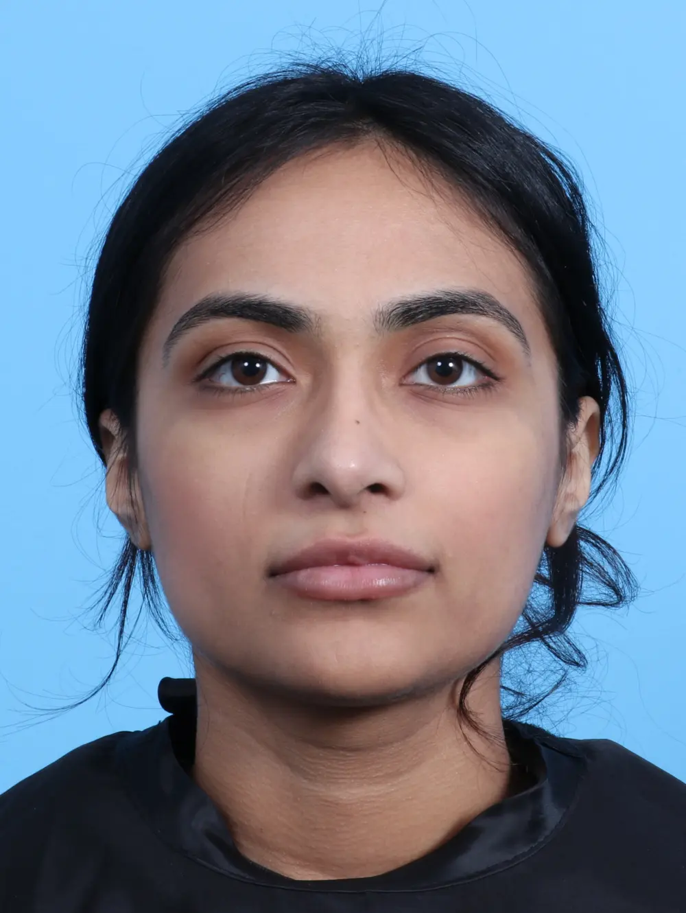 Rhinoplasty Patient Photo - Case 24815 - after view-2