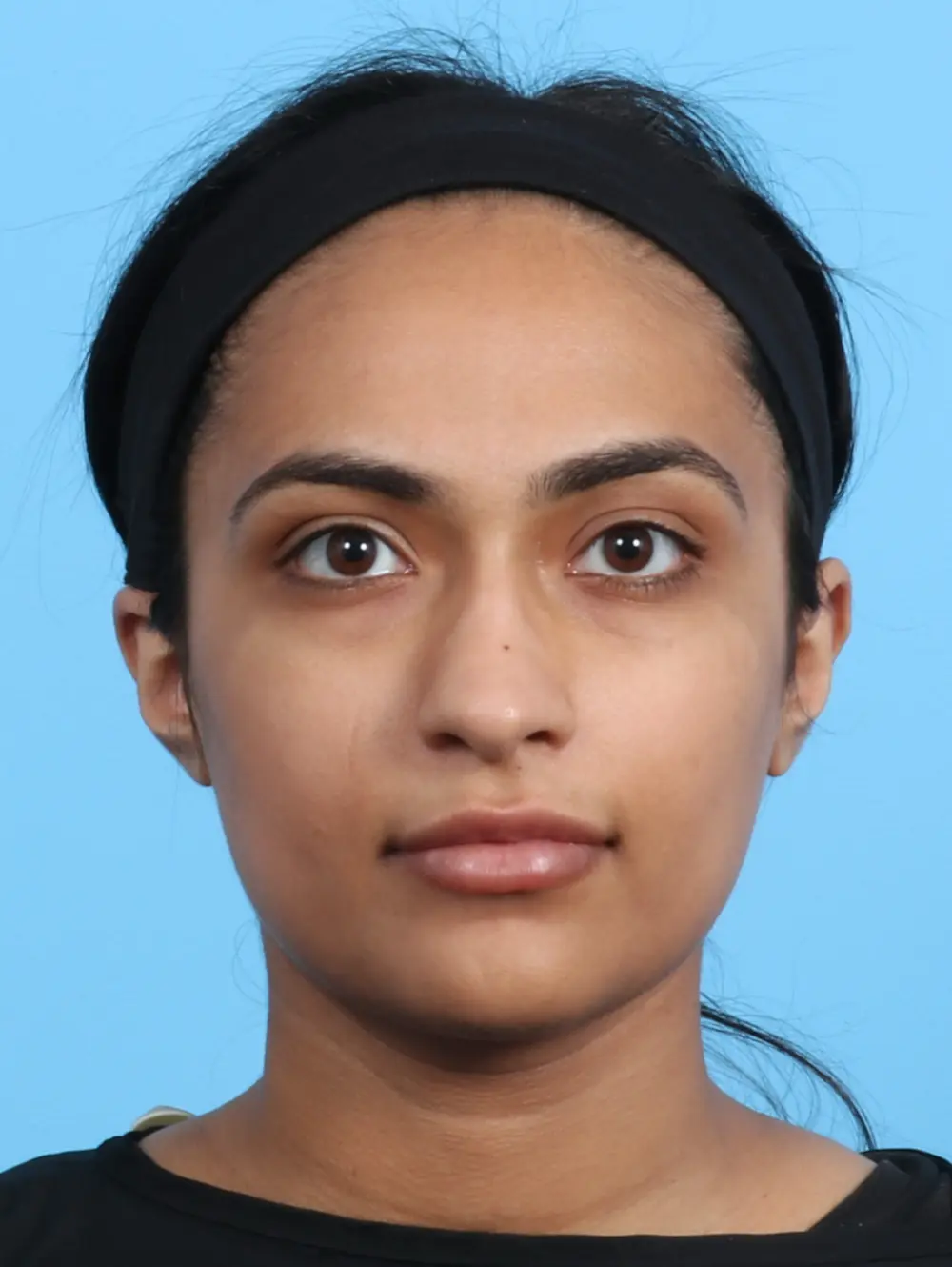 Rhinoplasty Patient Photo - Case 24815 - before view-2