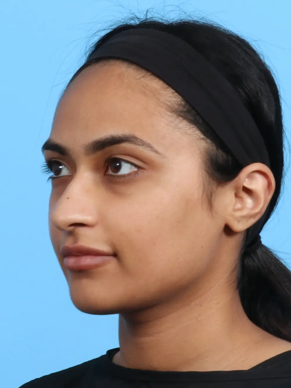 Rhinoplasty Patient Photo - Case 24815 - before view-1