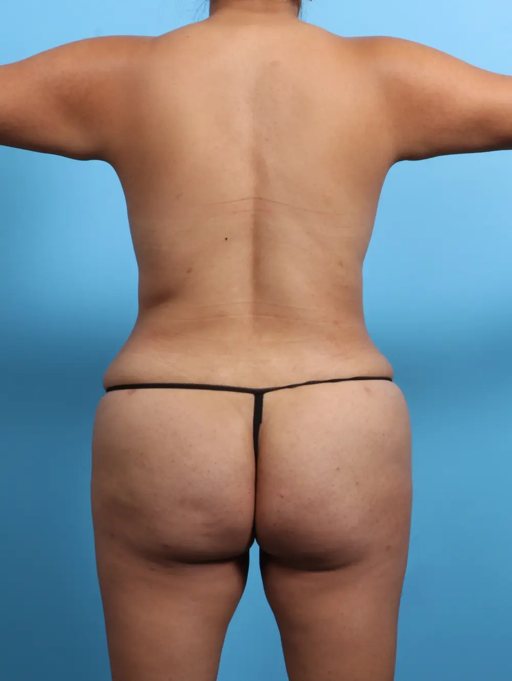 Breast Lift/Reduction with Implants Patient Photo - Case 24905 - after view-3