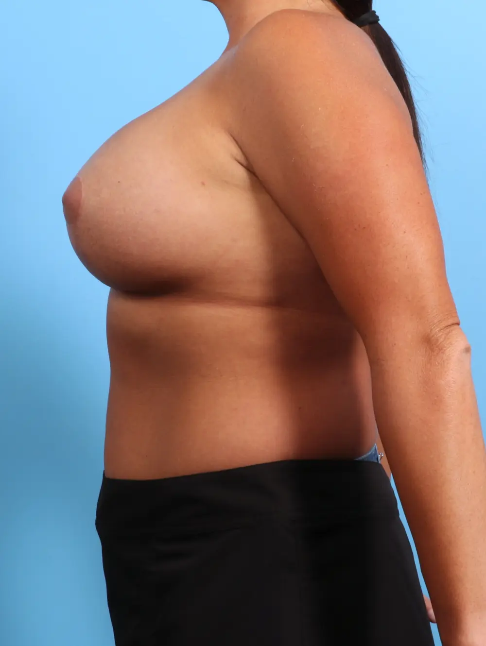 Breast Lift/Reduction with Implants Patient Photo - Case 24925 - after view-2