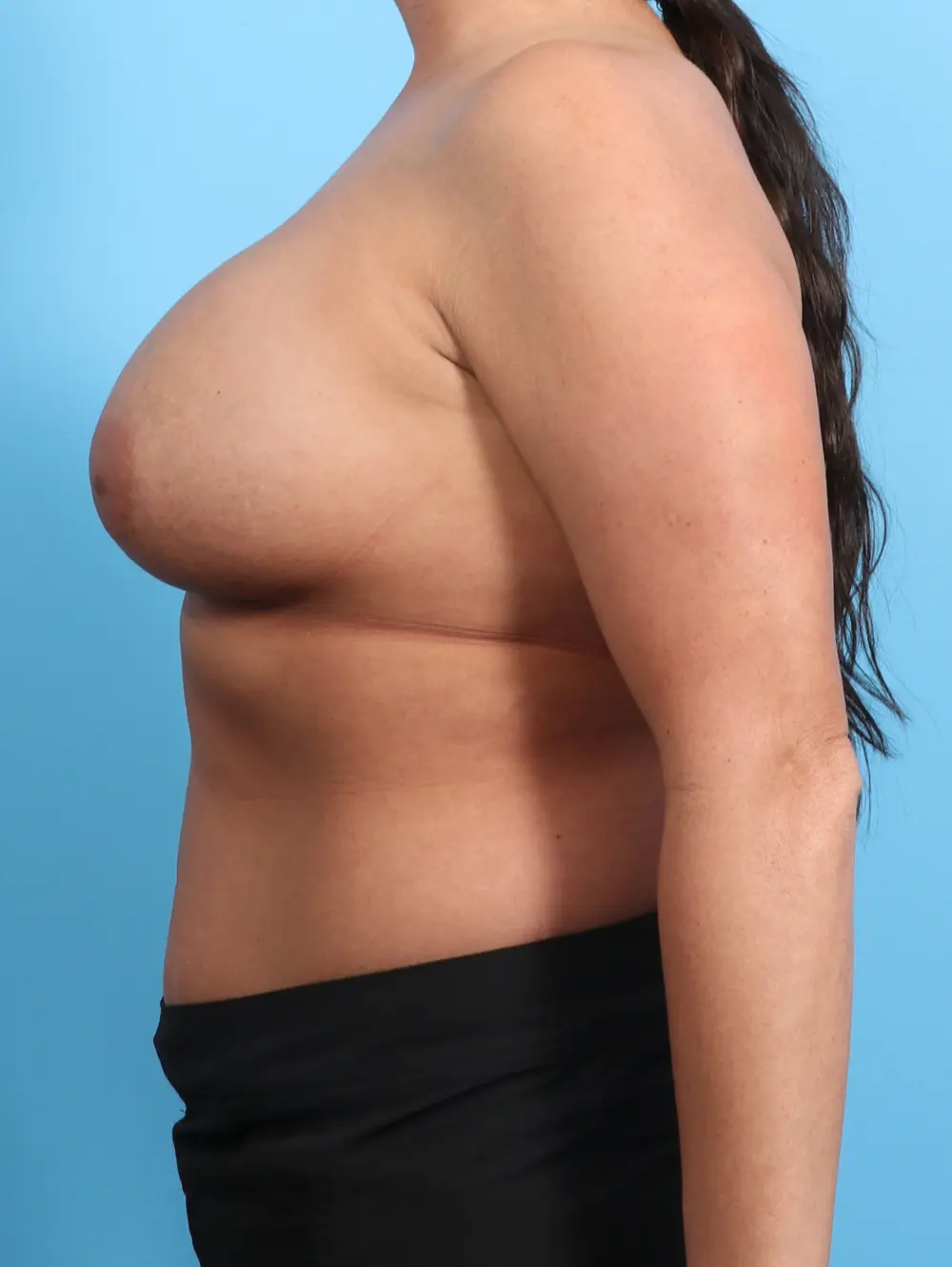Breast Lift/Reduction with Implants Patient Photo - Case 24925 - before view-2