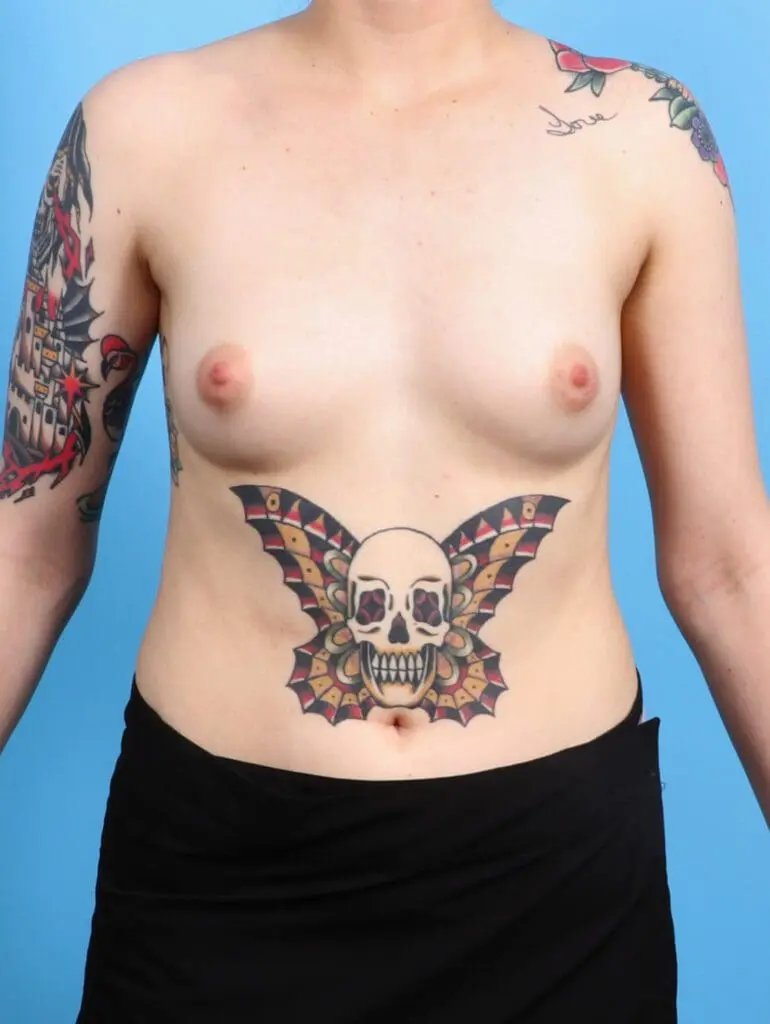 Breast Augmentation - Case 24934 - Before