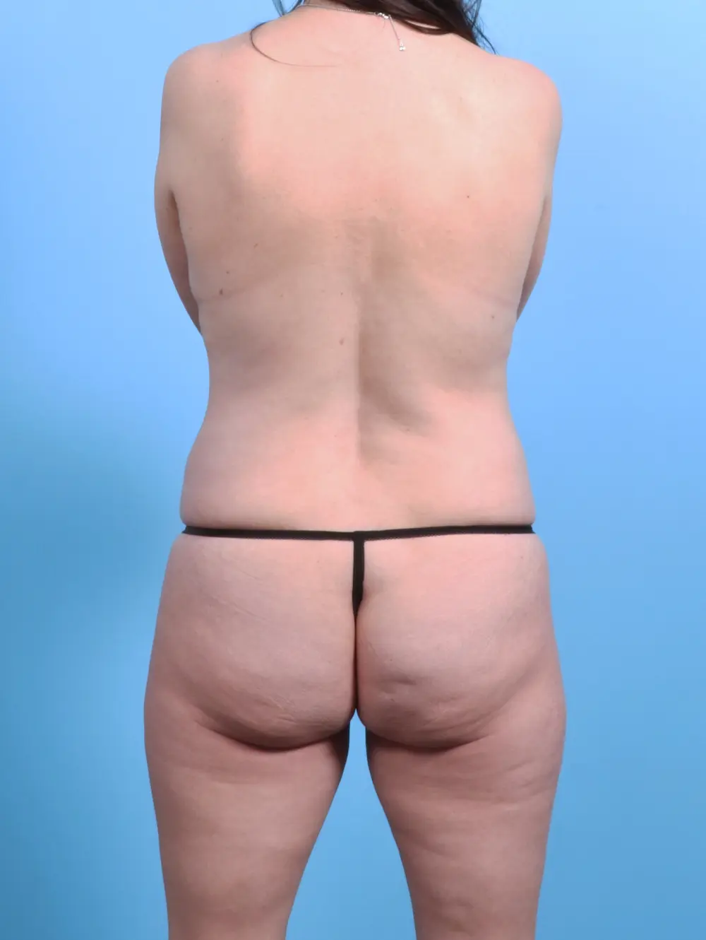 Breast Lift/Reduction with Implants Patient Photo - Case 24953 - before view-3