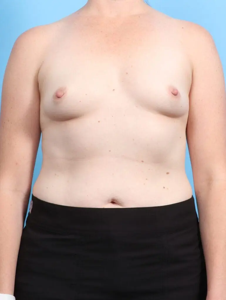 Breast Augmentation - Case 24963 - Before