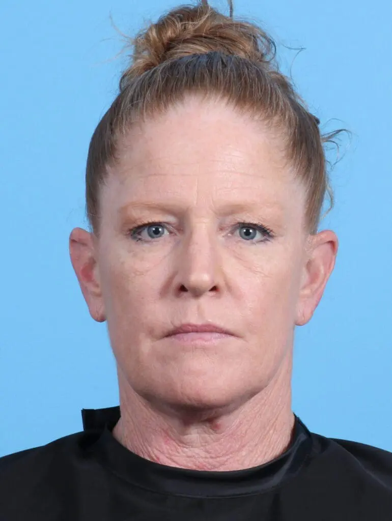 Eyelid Surgery - Case 24987 - Before