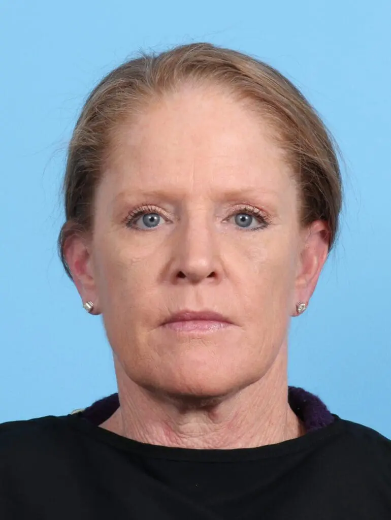 Eyelid Surgery - Case 24987 - After